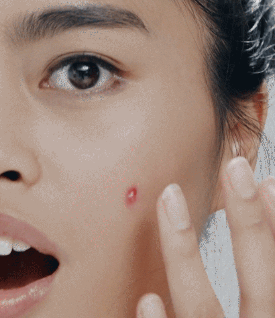 Acne Awareness